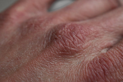 How Bone Broth may help Eczema